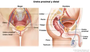 Urólogos preocupados por aumento cáncer de vejiga