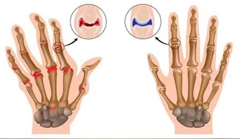 Una nueva cura para la artritis, reumatismo y problemas con articulaciones