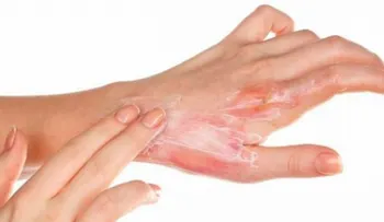 3 remedios imperdibles para las quemaduras de aceite de cocina