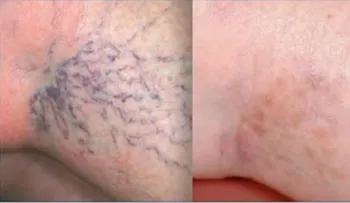 Cura las varices de tus pies con este poderoso remedio casero (VIDEO)