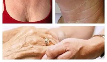 Tratamiento para prevenir arrugas en cuello y manos