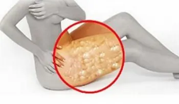 Truco para eliminar la celulitis con vinagre de manzana como por arte de magia!