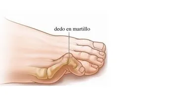 ¿Por qué duele tanto golpearse el dedito del pie?