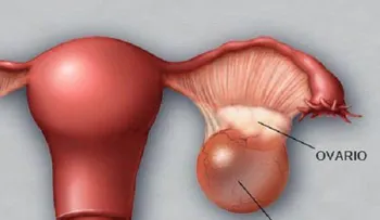 6 remedios que debes conocer para limpiar los quistes ováricos 