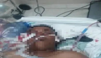 Presenta un edema cerebral raso PN que le propinaron un disparo en la cabeza