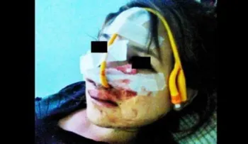Embarazada desfigurada por su novio por abrir cuenta en Facebook