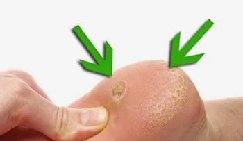 Crema casera para eliminar los callos de los pies