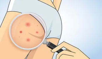 10 maneras de deshacerse del acné en las nalgas naturalmente