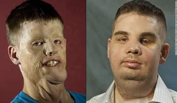 Hombre que recibió trasplante de rostro rompe su silencio y cuenta su experiencia