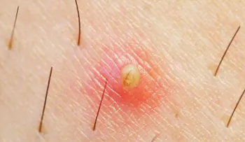 7 soluciones para eliminar los pelos enquistados