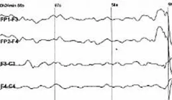 Crean un chip que podría prevenir la epilepsia  