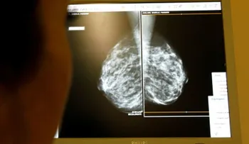 Investigadores canadienses hallan un método para impedir el cáncer de mama 