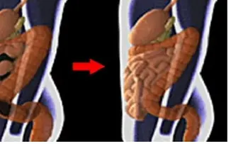 30 libras de toxinas en el colon, cómo limpiarla con dos ingredientes !!!