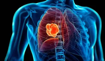 Inmunoterapia es una esperanza de vida para pacientes con cáncer de pulmón