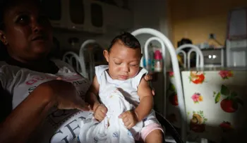 Seis preguntas y respuestas sobre la microcefalia, la enfermedad que podría estar relacionada con el zika