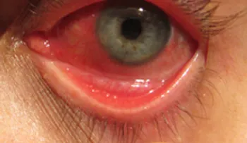 Zumo de perejil y lavados con eufrasia para la conjuntivitis