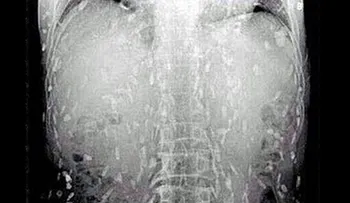 El cuerpo de un hombre se llenó de Gusanos después de comer Sushiâ?¦