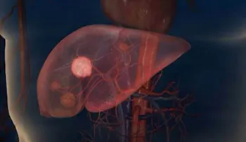 Cómo es el moderno tratamiento contra el cáncer de hígado