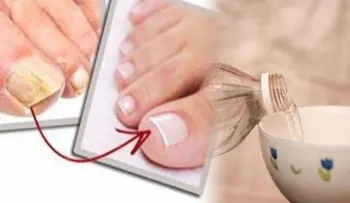 ¡Traté muchas formas para eliminar hongos de mis uñas, hasta que probé este remedio...!