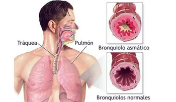 La bronquistis asmástica; síntomas y tratamiento