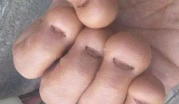 Un hombre muere de un infarto después de morderse las uñas