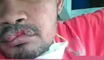 Recluso le arranca parte del labio a otro de una mordida en cárcel de Montecristi