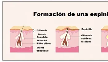 Espinillas dentro de la nariz, remedios naturales