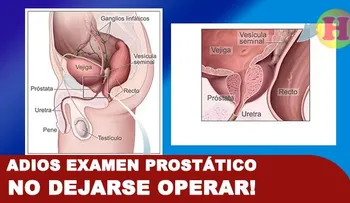 La próstata se agranda por la edad; alegan no es necesario operarla. Los limones pueden matar células cancerosas