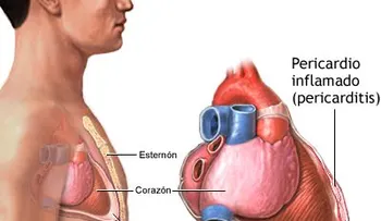 Pericarditis; causas y síntomas
