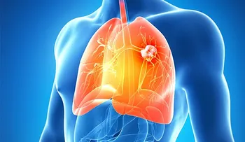 Te sorprenderá al ver que causa el cáncer de pulmón