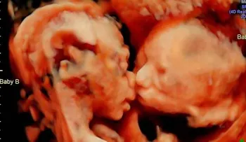 FOTO VIRAL: Ecografía capta a gemelas dándose un tierno beso en el vientre materno