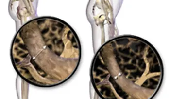 Enfermedades reumáticas y osteoporosis: tratamiento