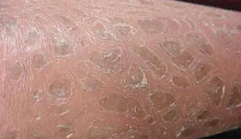  Ictiosis: nacer con una piel especial similar a las escamas de un pez 