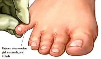 Tratamiento para hongos en las uñas o pie de atleta