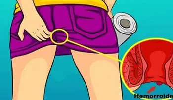 Dile adiós a las hemorroides por completo con estos remedios naturales 