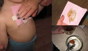 Con envoltura de jengibre y miel: Combatí mi tos y la mucosidad de mis pulmones en una sola noche