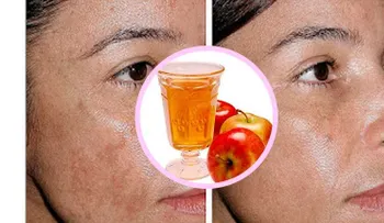 Coloca vinagre de manzana en tu cara y desparecerán tus manchas de la edad y toxinas 