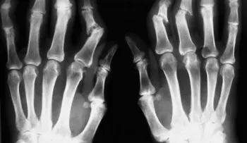 Artritis psoriásica: Inflamación y deformación articular