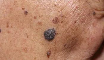 5 maneras de prevenir el cáncer de piel