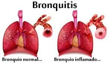 La bronquitis y los remedios para tratarla