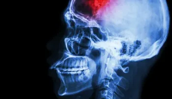 Las quejas de memoria y el riesgo de ictus están relacionados