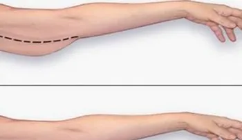 Entérate cómo eliminar la grasa del brazo sin recurrir a costosas cirugías