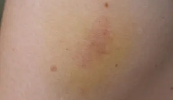 Si te salen moretones sin haberte golpeado, podrías tener alguna de estas enfermedades