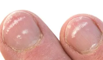 ¿Quieres saber por qué aparecen esas manchas blancas en las uñas? ¡Te ASOMBRARÁS!