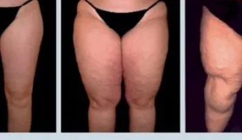 Lipedema, una dura enfermedad que debes conocer