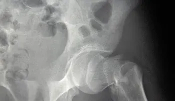 Niveles adecuados de magnesio evitan las fracturas óseas en los mayores