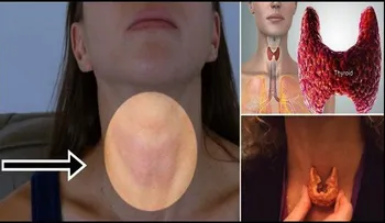 Autoexamen de cáncer de tiroides en 1 minuto