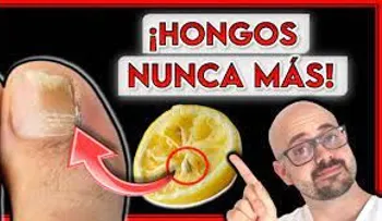 Remedios efectivos para hongos de los pies