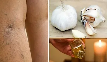 Dile adiós a las várices de las piernas naturalmente