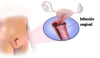 Remedios naturales para la vagina hinchada
